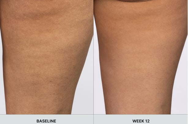 A before-and-after comparison of a woman's thighs using the WellSpa iO after 12 weeks.